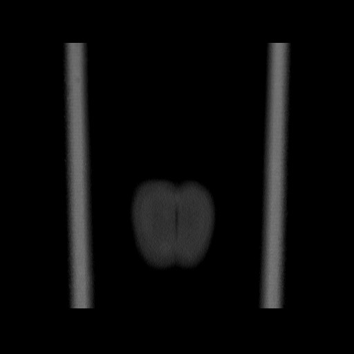 Chondrosarcoma of iliac wing (Radiopaedia 63861-72599 Coronal bone window 121).jpg