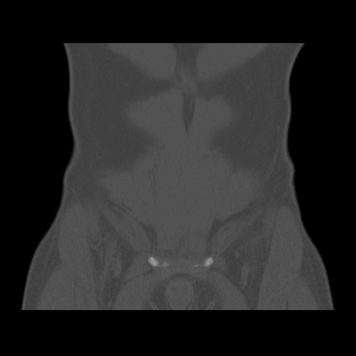 Chondrosarcoma of iliac wing (Radiopaedia 63861-72599 Coronal bone window 25).jpg