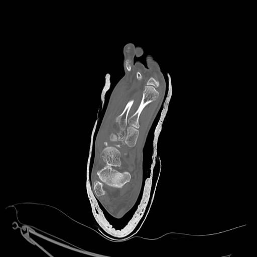 File:Chopart fracture (Radiopaedia 12386-12650 Axial bone window 11).jpg