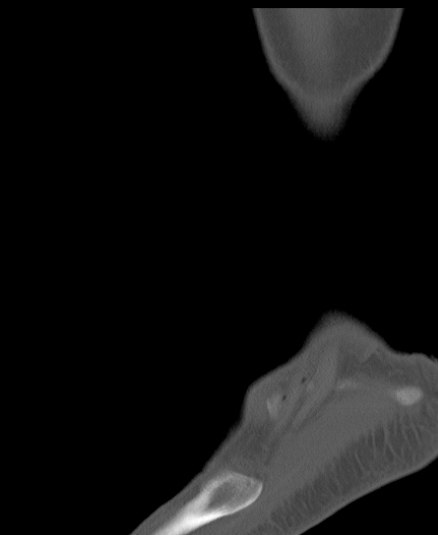 Chopart fracture (Radiopaedia 35347-36851 Sagittal bone window 56).jpg