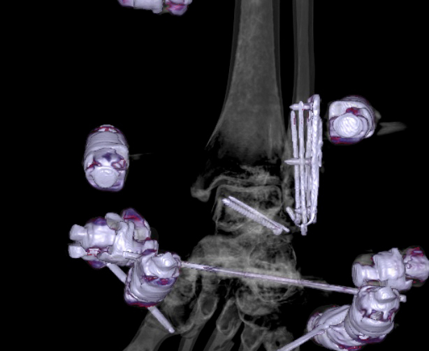 File:Chopart fracture (Radiopaedia 35347-36861 3D MPR bone window 3).jpg