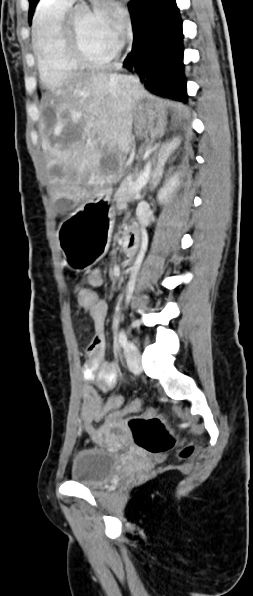 Choriocarcinoma liver metastases (Radiopaedia 74768-85766 C 85).jpg
