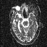 Choroid plexus xanthogranuloma - unilateral (Radiopaedia 85632-101393 Axial ADC 23).jpg