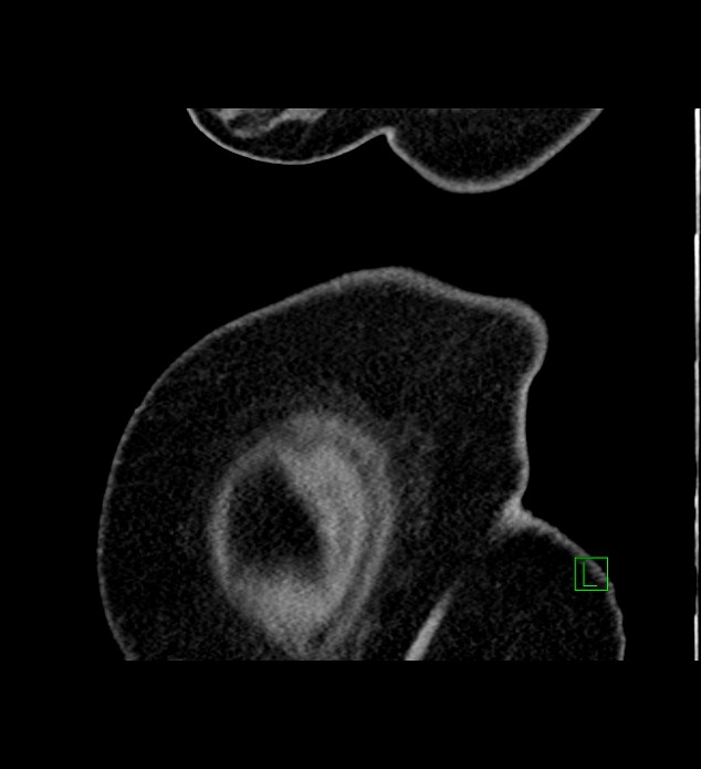 Chromophobe renal cell carcinoma (Radiopaedia 84239-99519 D 2).jpg