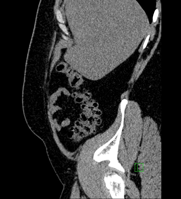 Chromophobe renal cell carcinoma (Radiopaedia 84286-99573 C 156).jpg