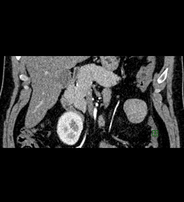 Chromophobe renal cell carcinoma (Radiopaedia 84286-99573 E 16).jpg