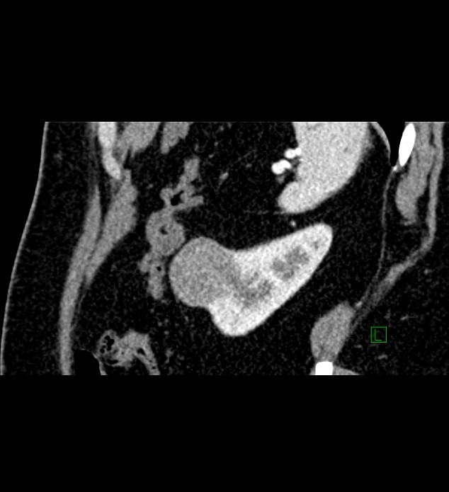 Chromophobe renal cell carcinoma (Radiopaedia 84286-99573 F 30).jpg