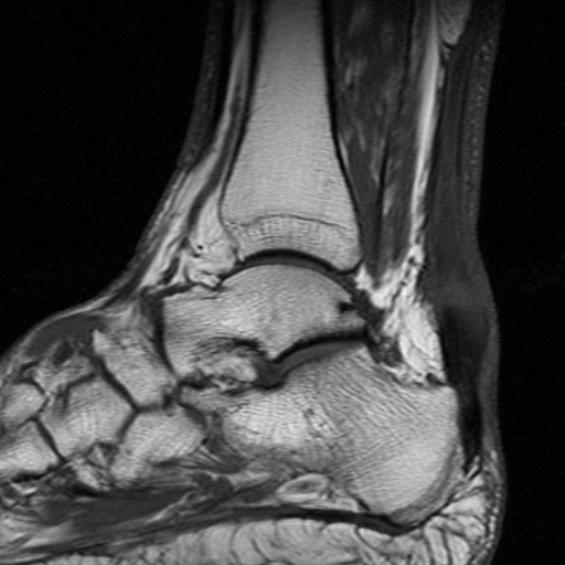 File:Chronic Achilles tendon rupture (Radiopaedia 15262-15100 Sagittal T1 7).jpg