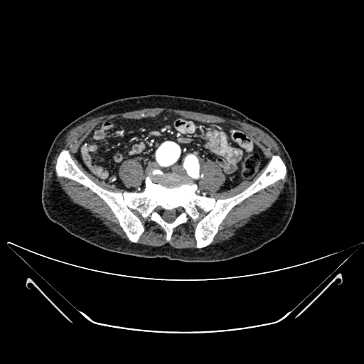 File:Chronic contained rupture of abdominal aortic aneurysm with extensive erosion of the vertebral bodies (Radiopaedia 55450-61901 A 51).jpg