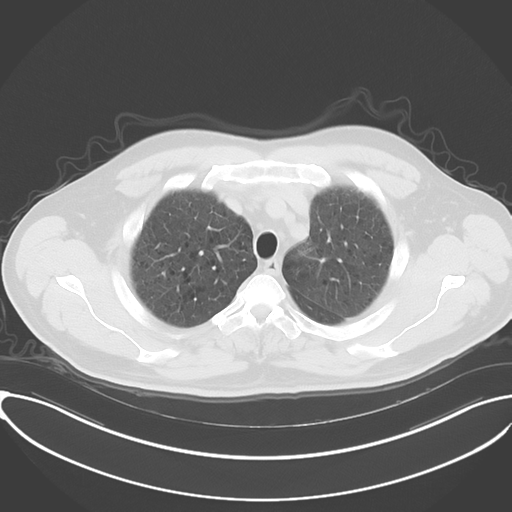 Chronic hypersensitivity pneumonitis (Radiopaedia 48107-52922 Axial lung window 16).png