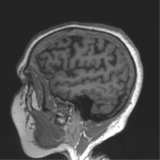 Chronic hypertensive encephalopathy (Radiopaedia 39993-42482 Sagittal T1 74).png