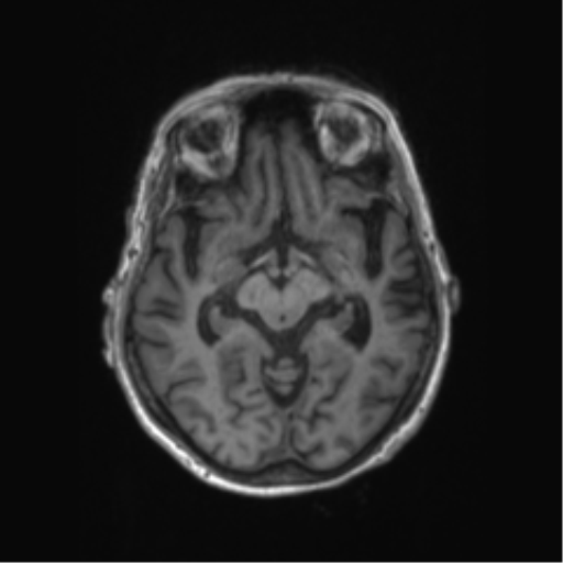 Chronic hypertensive encephalopathy (Radiopaedia 72844-83495 Axial T1 43).png