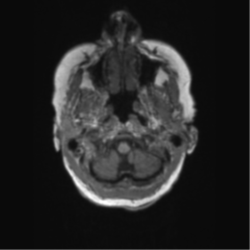 Chronic hypertensive encephalopathy (Radiopaedia 72844-83495 Axial T1 66).png