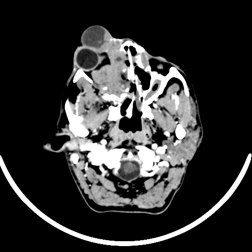 Chronic invasive fungal sinusitis with intraorbital and intracranial extension (Radiopaedia 56387-63046 B 62).jpg