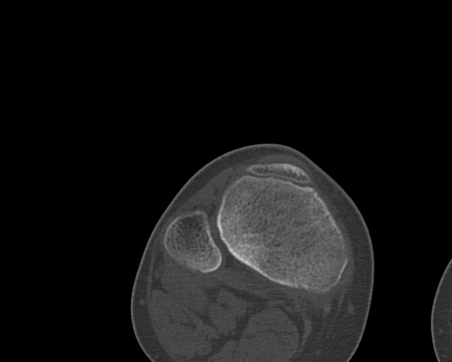 Chronic ostemyelitis of the femur with long sinus tract (Radiopaedia 74947-85982 Axial bone window 243).jpg