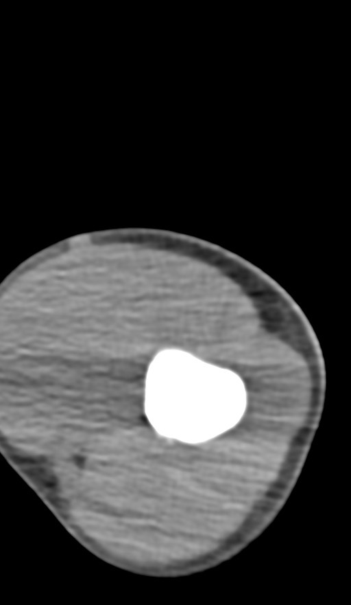 Chronic osteomyelitis of the distal humerus (Radiopaedia 78351-90971 Axial non-contrast 53).jpg