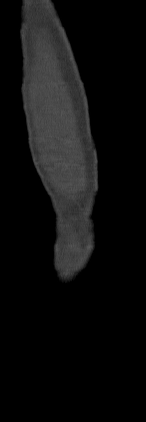 Chronic osteomyelitis of the distal humerus (Radiopaedia 78351-90971 Sagittal bone window 68).jpg