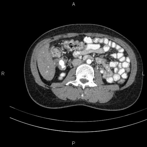 Chronic pancreatitis (Radiopaedia 64576-73450 B 83).jpg