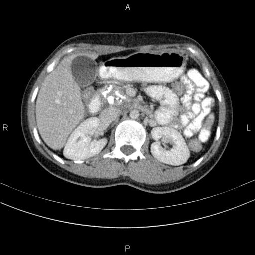 Chronic pancreatitis (Radiopaedia 64576-73450 C 55).jpg