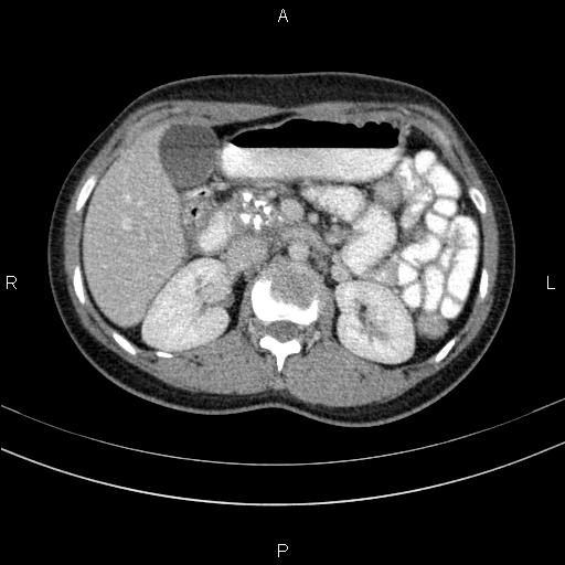 File:Chronic pancreatitis (Radiopaedia 64576-73450 C 58).jpg