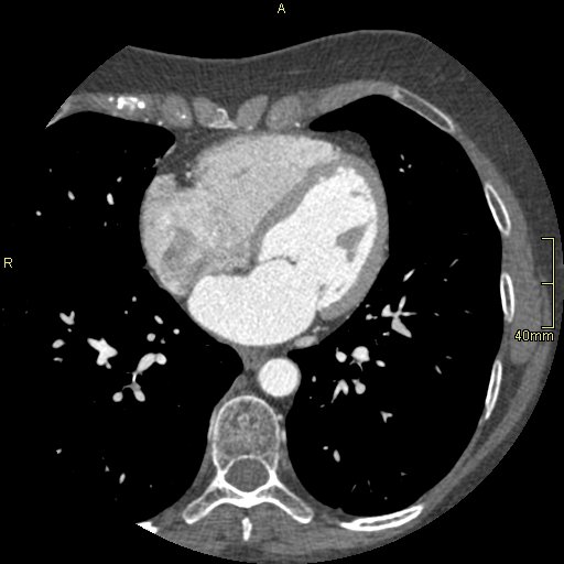 Chronic pulmonary embolism (Radiopaedia 73073-85094 Axial C+ CTPA 95).jpg