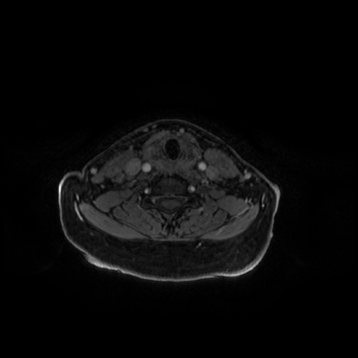 Chronic submandibular sialadenitis (Radiopaedia 61852-69885 Axial T1 C+ fat sat 17).jpg