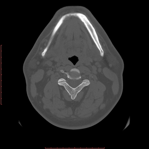 Chronic submandibular sialolithiasis (Radiopaedia 69817-79814 Axial bone window 79).jpg