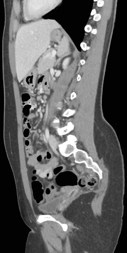 Circumaortic left renal vein with a duplicated retroaortic vein (Radiopaedia 91668-109398 C 74).jpg