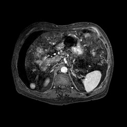 Cirrhosis and hepatocellular carcinoma in the setting of hemochromatosis (Radiopaedia 75394-86594 Axial T1 C+ fat sat 216).jpg