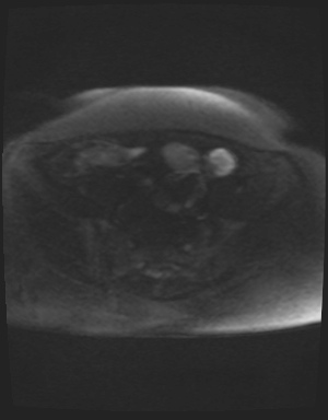 Class II Mullerian duct anomaly- unicornuate uterus with rudimentary horn and non-communicating cavity (Radiopaedia 39441-41755 Axial DWI 71).jpg