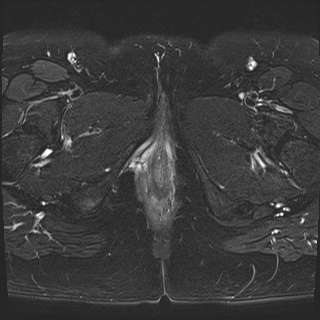 File:Class II Mullerian duct anomaly- unicornuate uterus with rudimentary horn and non-communicating cavity (Radiopaedia 39441-41755 Axial T2 fat sat 29).jpg