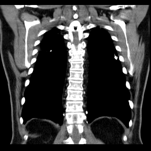 File:Classic complicated silicosis (Radiopaedia 49720-54961 Coronal liver window 49).jpg