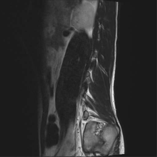 File:Clear cell meningoma - lumbar spine (Radiopaedia 60116-67690 Sagittal T2 1).png
