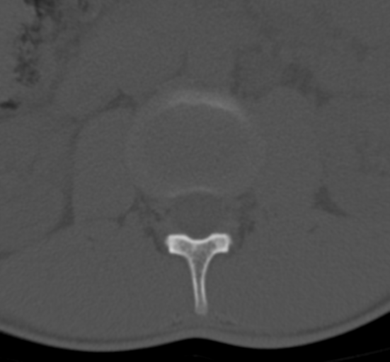 Clear cell meningoma - lumbar spine (Radiopaedia 60116-67691 Axial bone window 20).png