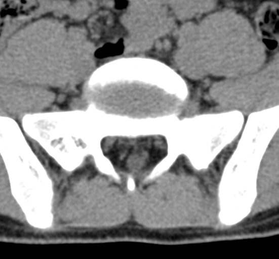 File:Clear cell meningoma - lumbar spine (Radiopaedia 60116-67691 Axial non-contrast 67).png