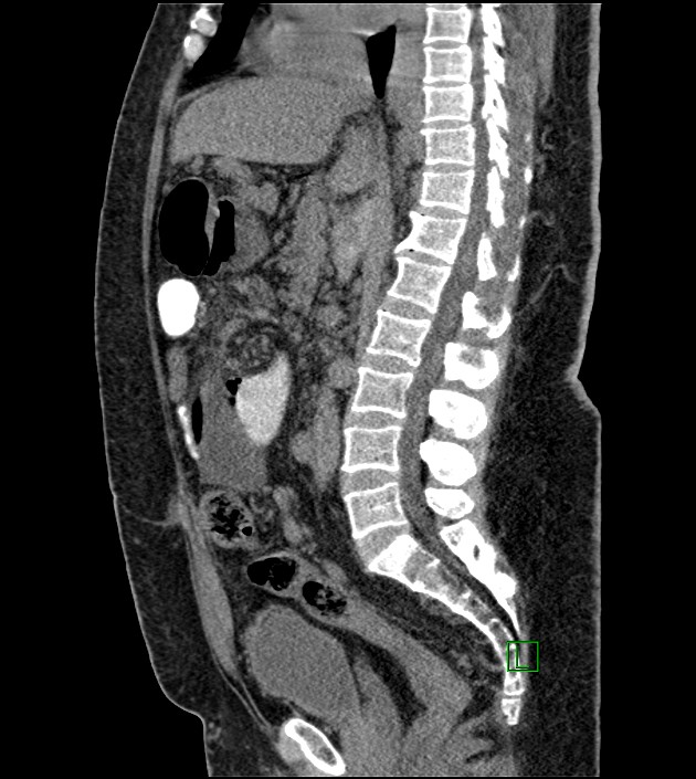 Closed-loop small bowel obstruction-internal hernia (Radiopaedia 78439-91096 C 78).jpg