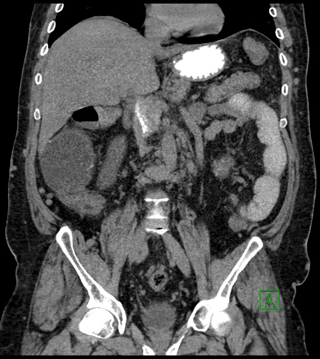 Closed-loop small bowel obstruction-internal hernia (Radiopaedia 78439-91096 Coronal non-contrast 55).jpg