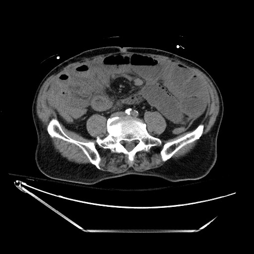 Closed loop obstruction due to adhesive band, resulting in small bowel ischemia and resection (Radiopaedia 83835-99023 Axial non-contrast 98).jpg