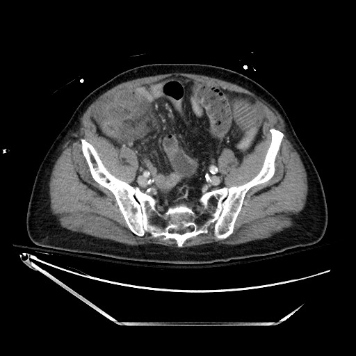 Closed loop obstruction due to adhesive band, resulting in small bowel ischemia and resection (Radiopaedia 83835-99023 D 119).jpg