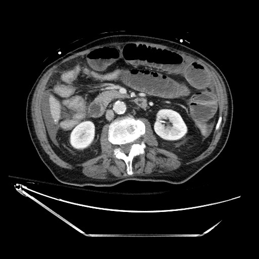 File:Closed loop obstruction due to adhesive band, resulting in small bowel ischemia and resection (Radiopaedia 83835-99023 D 70).jpg