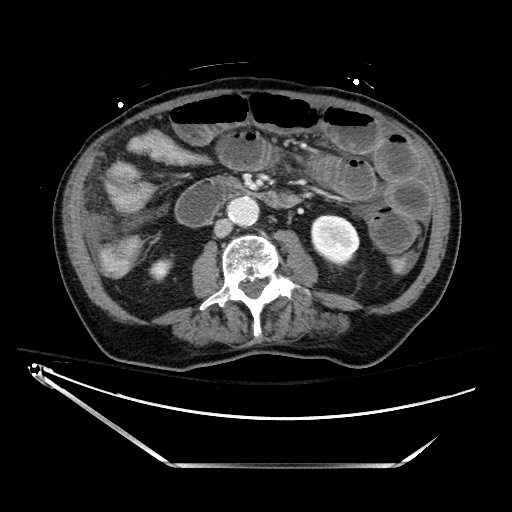 Closed loop obstruction due to adhesive band, resulting in small bowel ischemia and resection (Radiopaedia 83835-99023 D 78).jpg