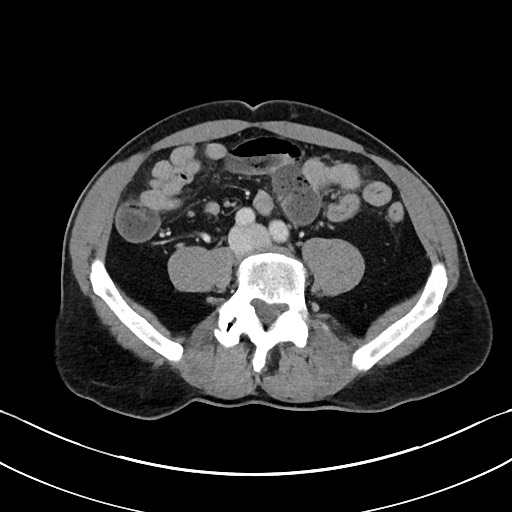 Closed loop small bowel obstruction - internal hernia (Radiopaedia 57806-64778 B 79).jpg