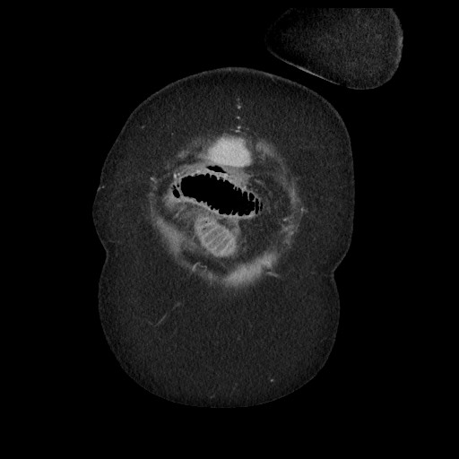 Closed loop small bowel obstruction - internal hernia (Radiopaedia 65402-74450 B 10).jpg