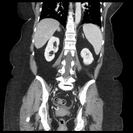 Closed loop small bowel obstruction - internal hernia (Radiopaedia 65402-74450 B 76).jpg