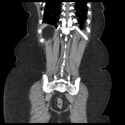 Closed loop small bowel obstruction - internal hernia (Radiopaedia 65402-74450 B 91).jpg