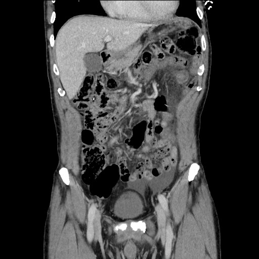 File:Closed loop small bowel obstruction - omental adhesion causing "internal hernia" (Radiopaedia 85129-100682 B 47).jpg