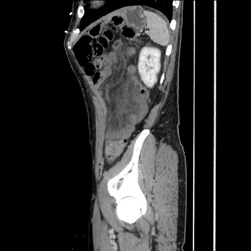 Closed loop small bowel obstruction - omental adhesion causing "internal hernia" (Radiopaedia 85129-100682 C 143).jpg