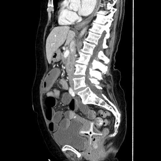 Closed loop small bowel obstruction due to adhesive band, with intramural hemorrhage and ischemia (Radiopaedia 83831-99017 D 102).jpg