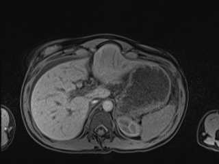 Closed loop small bowel obstruction in pregnancy (MRI) (Radiopaedia 87637-104031 Axial T1 fat sat 30).jpg