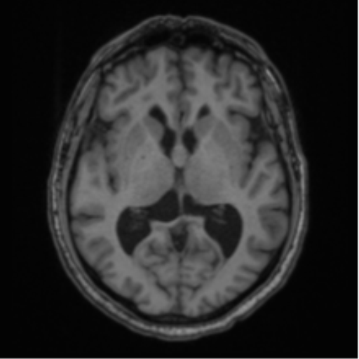 File:Colloid cyst of the third ventricle (Radiopaedia 86571-102662 Axial T1 39).png
